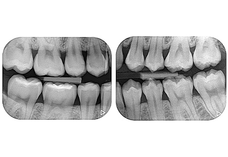 定期検診時のバイトウイングを併用したチェック