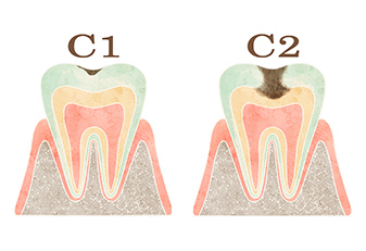​​(C1～C2)　軽度のむし歯治療​​