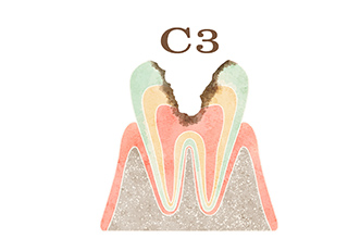 ​​(C3)　神経まで達したむし歯治療