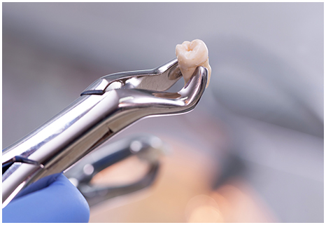 抜歯即時インプラントにも対応