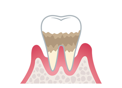 中度歯周病